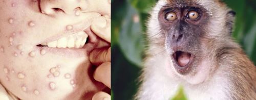  ماهي سبل الوقاية من جدري القرود ؟ و سائل علاجه ؟