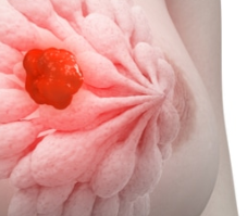 سرطان الثدي معلومات