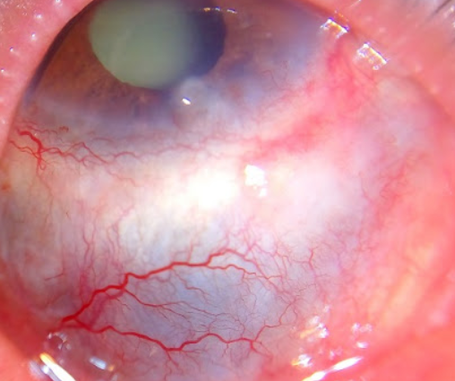أمراض شبكية العين معلومات
