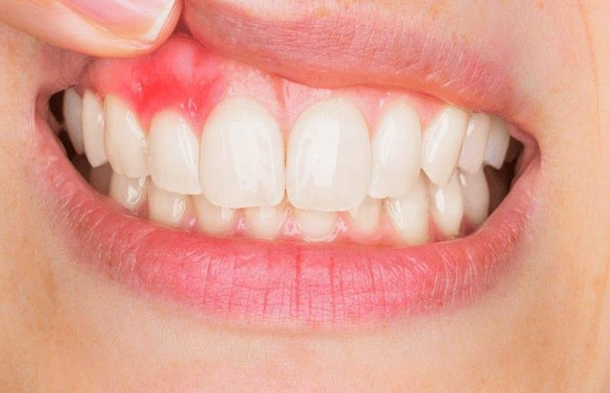 طرق علاج إلتهاب الأسنان حقائق و أسرار
